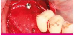 The graft mixture was covered with a resorbable collagen membrane (SMARTBRANE) and fixed with pins