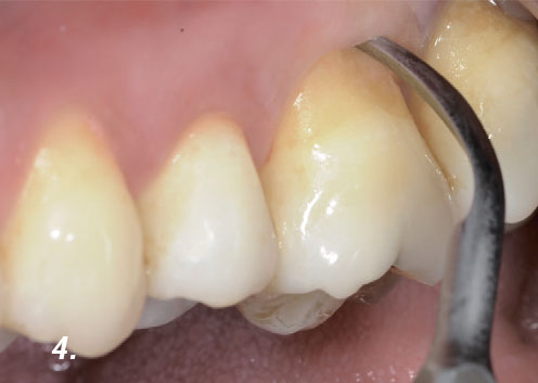 Ultraheliseadmega eemaldati hambakivi