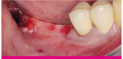 Patient with a distal mandibular edentulous ridge requiring implant placement